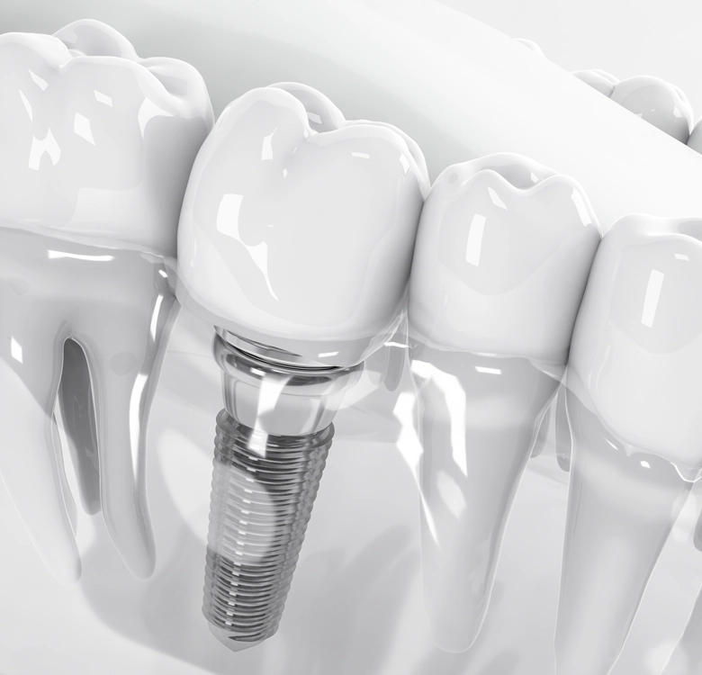dental service implant - Smile Well Dental Langley