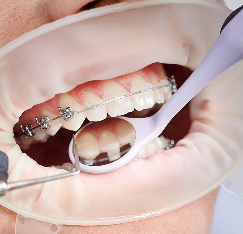 Dental Services -Orthodontics