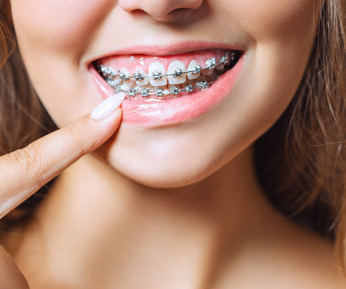 Orthodontics - Smile Well Dental Langley